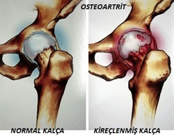 kalçaprotezi