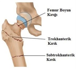 kalçakırığı