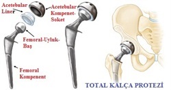 kalçaprotezi