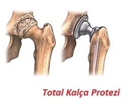 <a class='hightlight' href='https://www.eortopedi.com/kalca-kireclenmesi' title='kalça kireçlenmesi'>kalça kireçlenmesi</a>