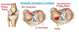 menisküsyırtığı