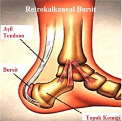 topukağrısı