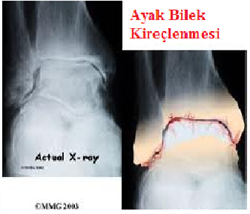 ayakbileğikireçlenme