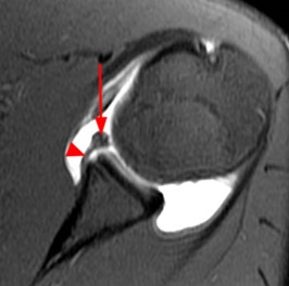 Bankart lezyonu MRI