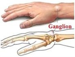 Ganglion