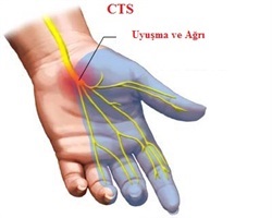 El Bileğinde Sinir Sıkışması 