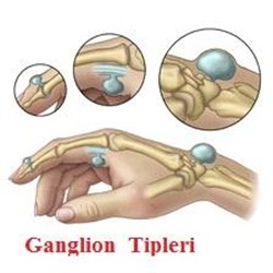 Ganglion