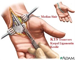 el bileginde sinir sikismasi