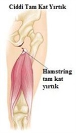 Hamstring Kas Gerilmesi