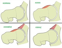 kalçaeklemisıkışması