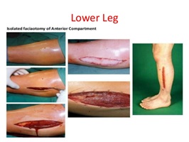 Akut Kompartman Sendromu 