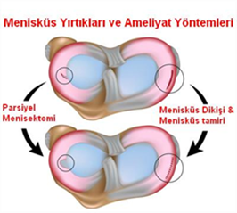 menisküs