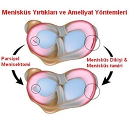 menisküsyırtığı