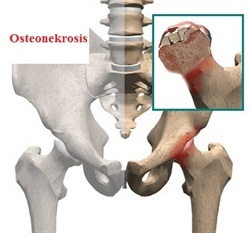 Femurbaşı Avasküler Nekroz