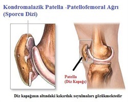 Sporcularda Diz Ağrısı