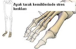 Stres Kırığı