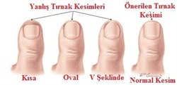 tırnakbatması