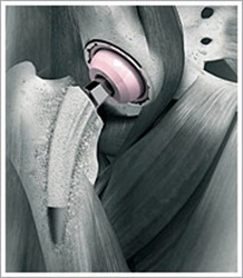 Total Hip Artroplasti Total Hip Artroplasti