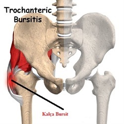 kalçabursit